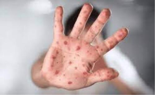 شباهت علایم آبله میمونی و آبله مرغان