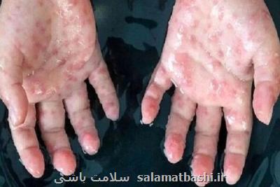 مراقبت مرزی برای مقابله با آبله میمون