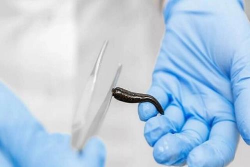 زالو درمان می کند؟