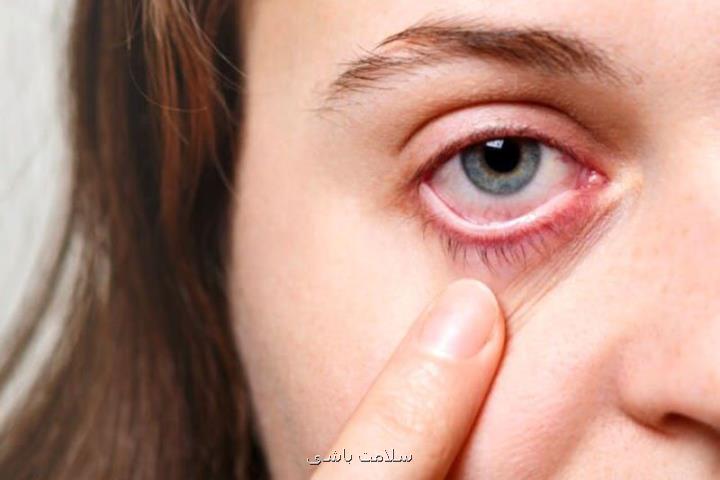 چشم هم سکته می کند؟