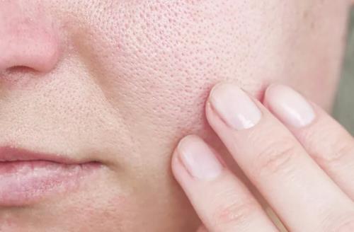 با منافذ باز پوست چه کنیم؟