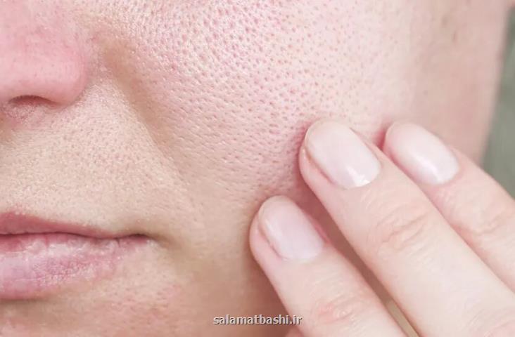 با منافذ باز پوست چه کنیم؟