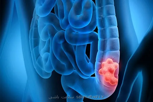 غربالگری و کاهش خطر مرگ ناشی از سرطان روده بزرگ